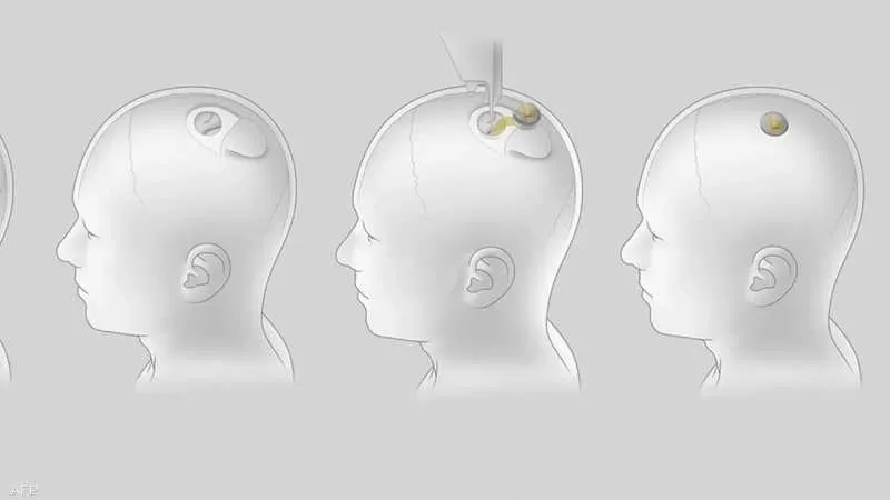 ابتكار وضع شريحة في الدماغ قد تتيح التحكم بالشلل