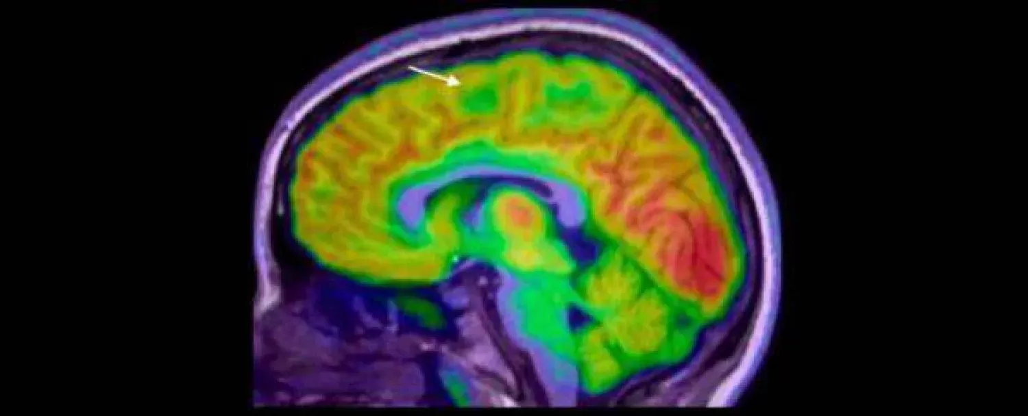 بحوث تنجح في التأكيد من مساعدة الذكاء الاصطناعي بتشخيص"الصرع"