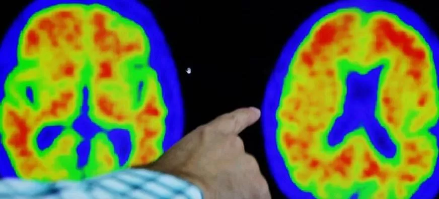 دراسة تكشف تقلص أدمغة الذكور أسرع من الإناث مع التقدم في العمر